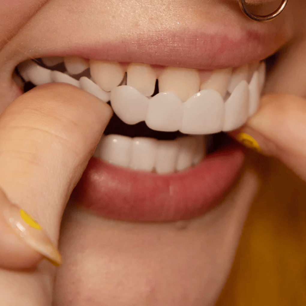 Sofortige Lächelverwandlung mit Snap on Smile Veneers