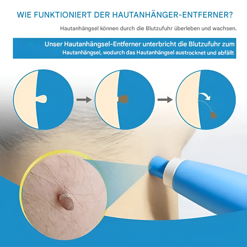 Kit zur Entfernung von Hautflecken